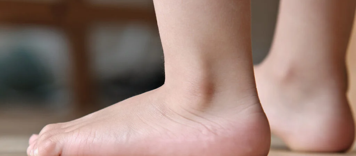 heraviphysio_flat-foot